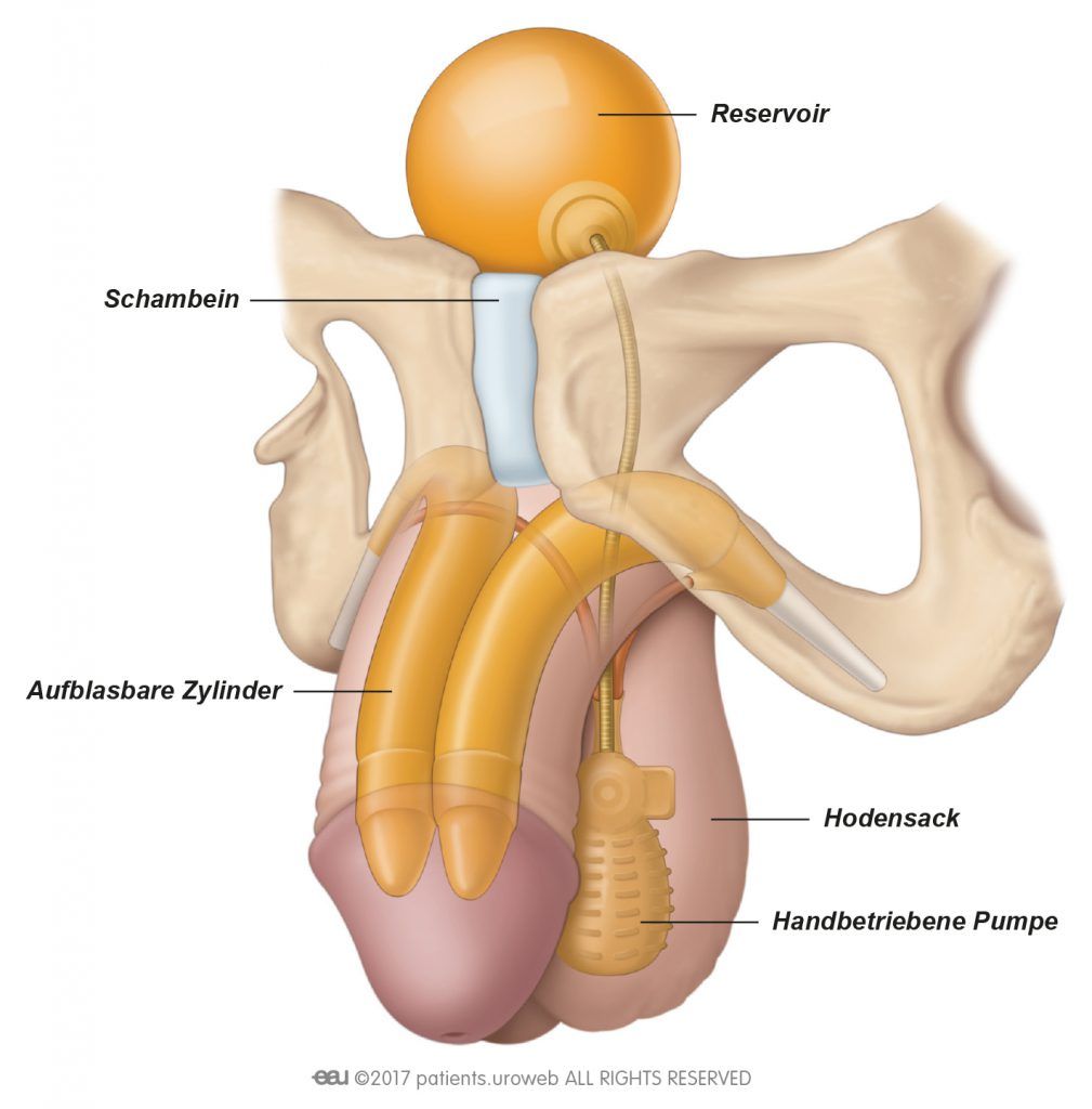 Abb. 1: Gebräuchlicher Typ eines aufblasbaren Penis-Implantats.